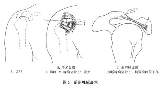 冈上肌腱修补术：手术步骤、术后恢复、并发症及合并肱骨骨折伤残评定