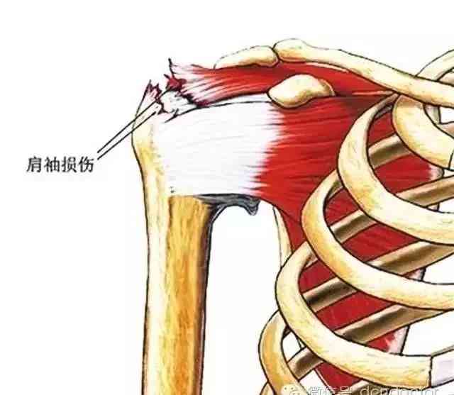 冈上肌腱修补术：手术步骤、术后恢复、并发症及合并肱骨骨折伤残评定