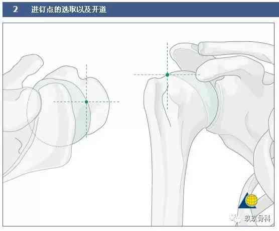 冈上肌腱修复手术费用解析：涵不同类型、程度及医院级别价格范围