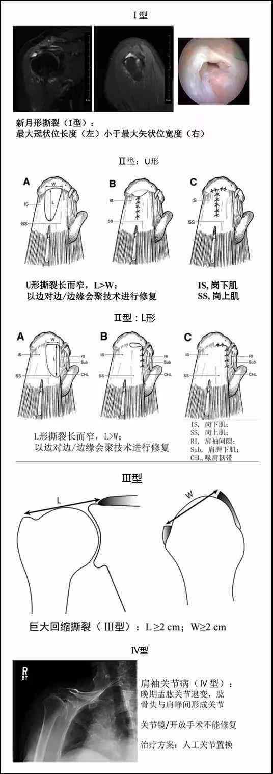 冈上肌腱断裂伤残等级鉴定与评定标准探讨