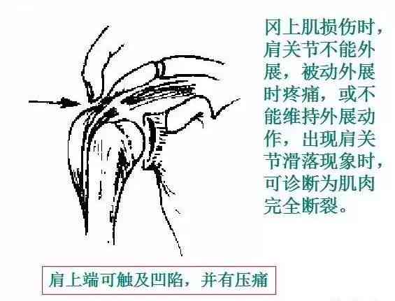 冈上肌腱断裂伤残等级鉴定与评定标准探讨