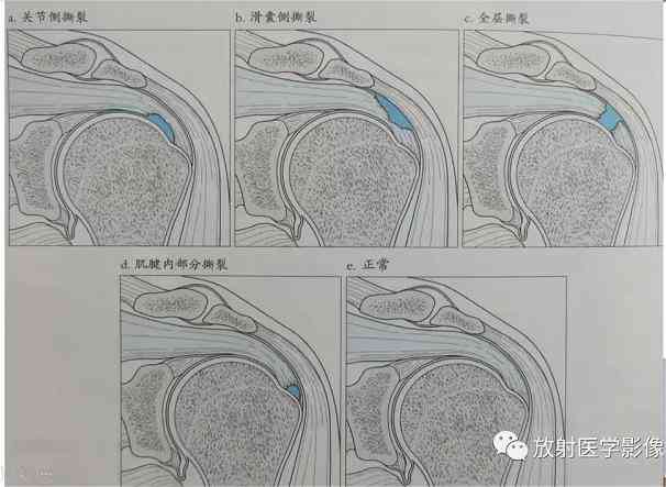 冈上肌腱断裂伤残等级鉴定与评定标准探讨