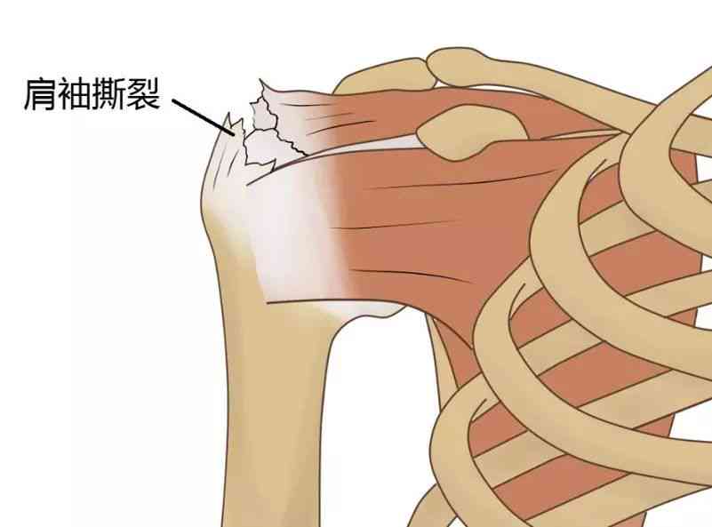 冈上肌腱修补能认定工伤吗