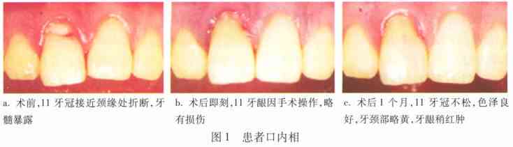 牙冠根折断拔出可以定残吗：牙齿损伤鉴定与法律判定标准探讨