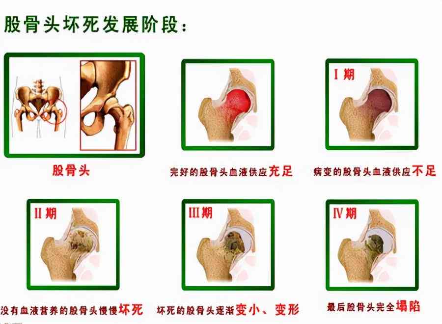 创伤性关节炎的伤残评级标准及认定流程详解