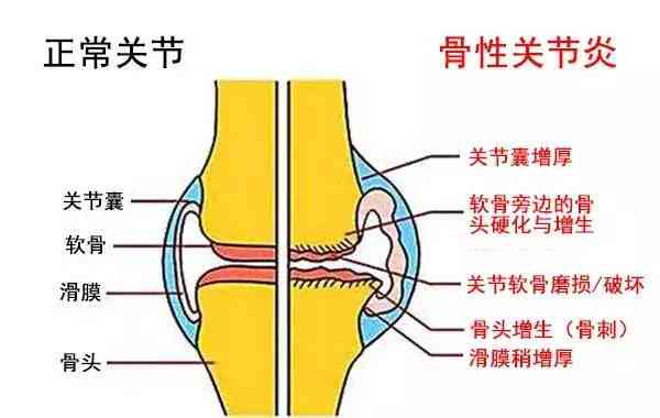 创伤性关节炎能认定工伤等级吗：认定标准及赔偿与评级解析