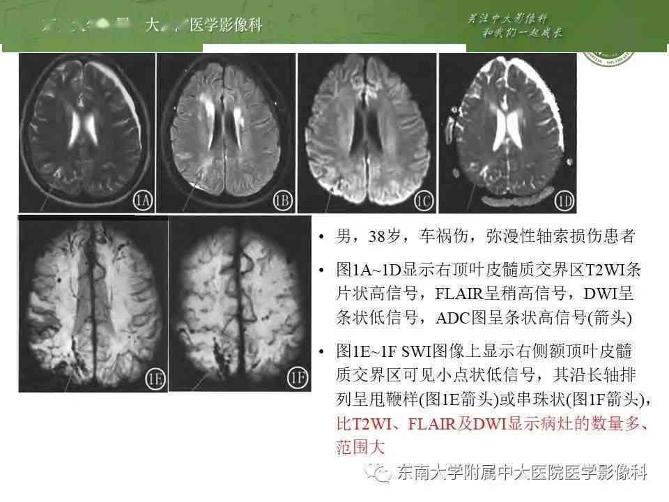 创伤性脑出血有没有可能完全复：治疗与恢复探讨