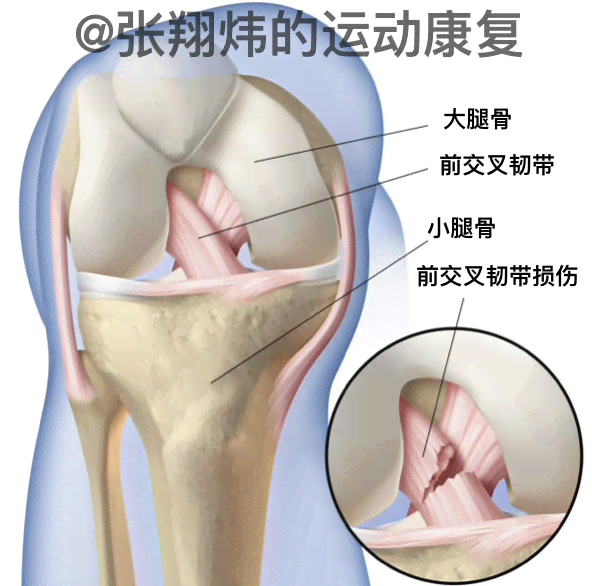 职工运动损伤前交叉韧带断裂获工伤认定