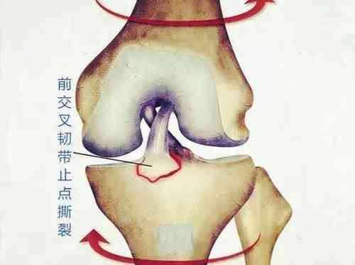 职工运动损伤前交叉韧带断裂获工伤认定