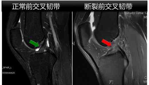 职工运动损伤前交叉韧带断裂获工伤认定