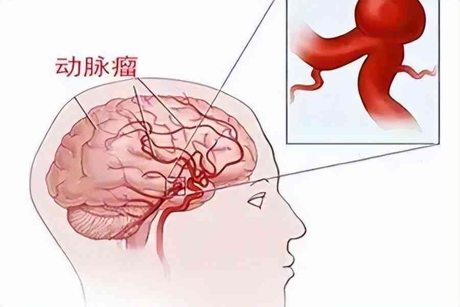 脑动脉瘤破裂与工伤认定：是否属于工伤及是否算重大疾病探讨