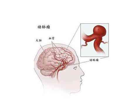 脑动脉瘤破裂与工伤认定：是否属于工伤及是否算重大疾病探讨