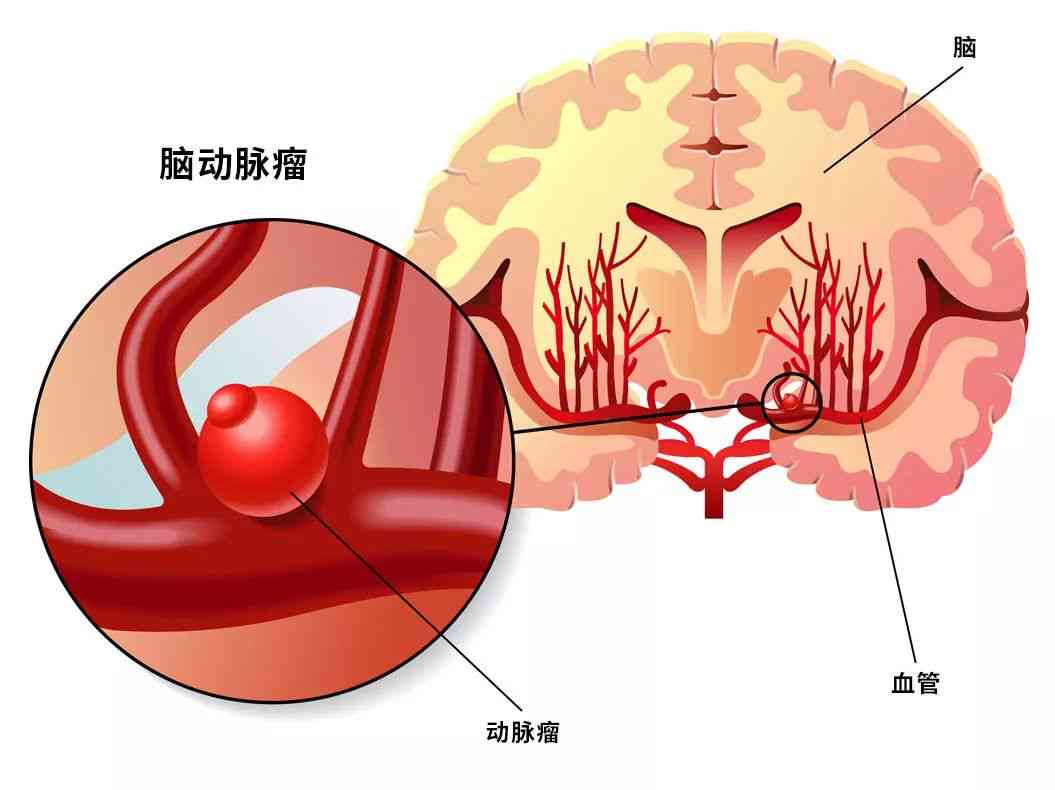 脑动脉瘤破裂与工伤认定：是否属于工伤及是否算重大疾病探讨