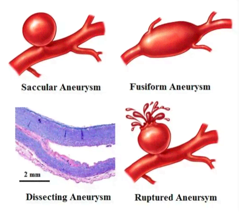 动脉瘤破裂是否被归类为重大疾病——探讨其医学定义及影响'