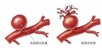 动脉瘤破裂是否被归类为重大疾病——探讨其医学定义及影响'