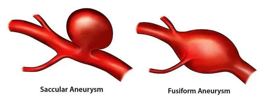动脉瘤破裂属于意外吗：动脉瘤破裂算重大疾病及其危险性和概率分析