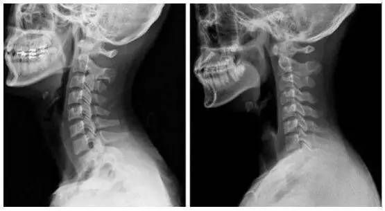 变形的颈椎还能恢复吗：颈椎变形能否回归正常及改善方法探讨