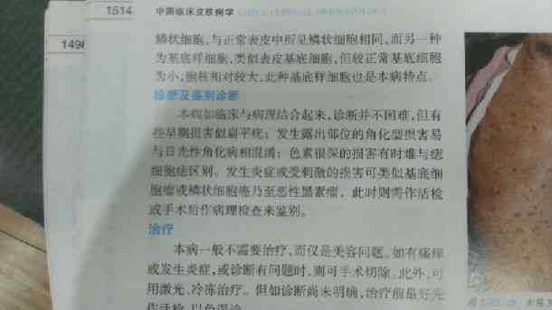 肺结核工伤认定及赔偿细则：涵医疗、生活补助与工伤待遇全解析