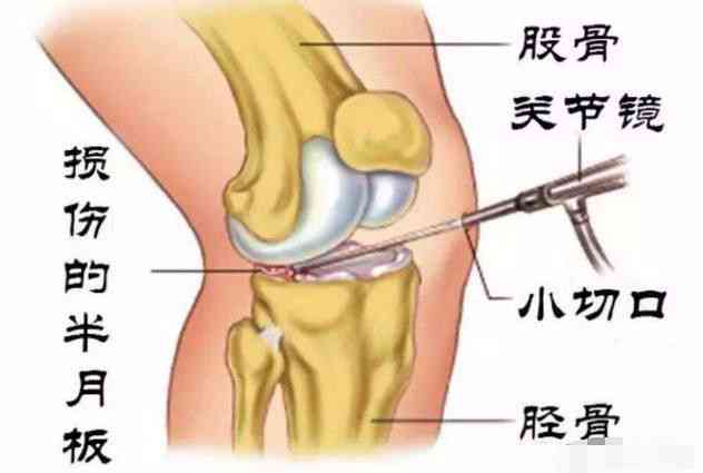 工伤半月板二度损伤赔偿详析：误工费、伤残补助及     要点全解读