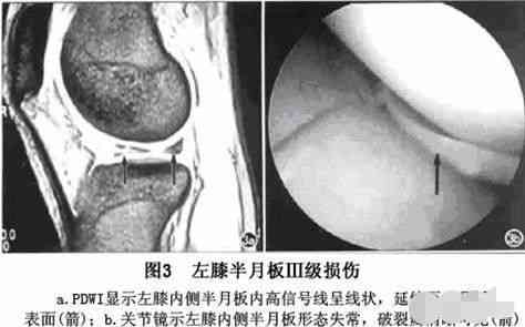 工伤半月板二度损伤赔偿详析：误工费、伤残补助及     要点全解读