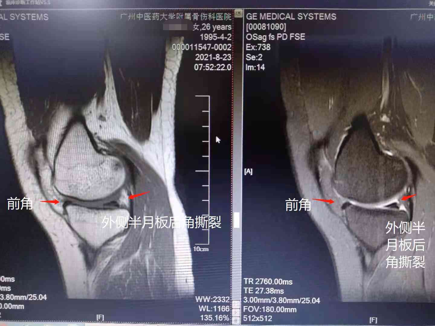 膝关节半月板损伤劳动工伤等级认定及伤残级别划分