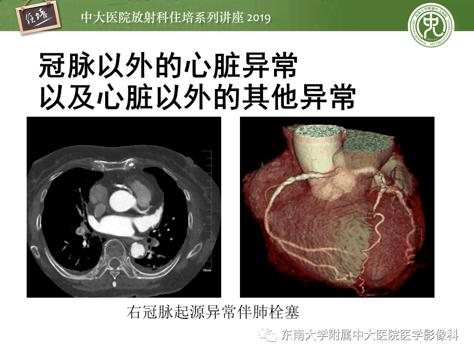 半月板劳损工伤认定全解析：如何判断与申请流程详解