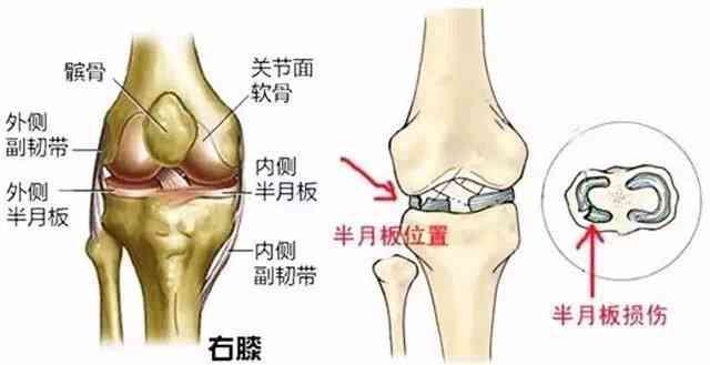 膝关节半月板劳损是否属于工伤认定范畴