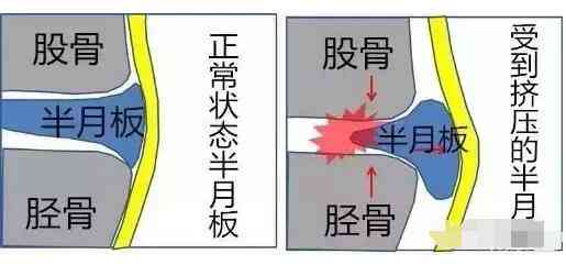 工作原因导致的半月板损伤：工伤认定标准与鉴定级别解析