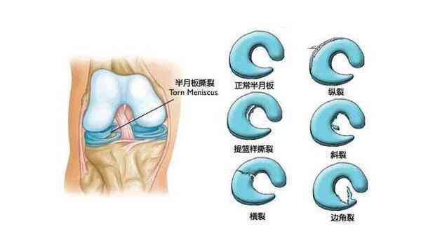 半月板损伤可以申请工伤吗：赔偿标准及评残资格解析