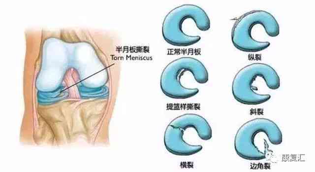 工作中的半月板损伤：详解其工伤认定标准与赔偿事宜