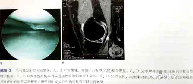 工作中的半月板损伤：详解其工伤认定标准与赔偿事宜