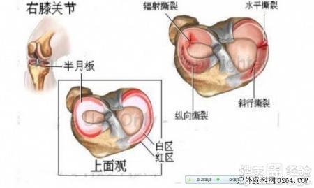 膝关节半月板损伤工伤认定及赔偿标准详解