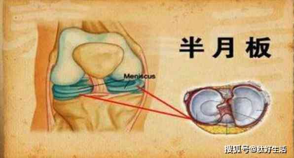 半月板损伤五年能恢复吗：治疗费用、手术必要性及恢复情况探讨