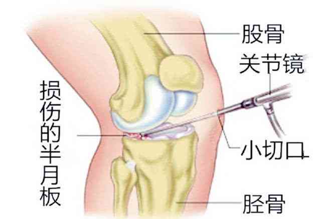 五年病：半月板损伤复之路追踪