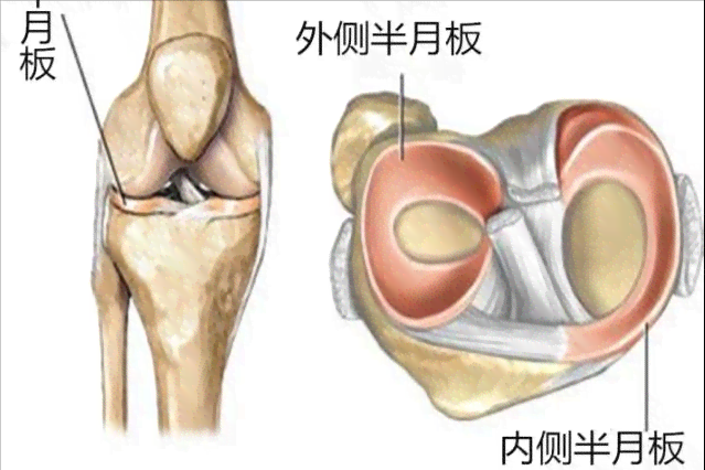 五年病：半月板损伤复之路追踪