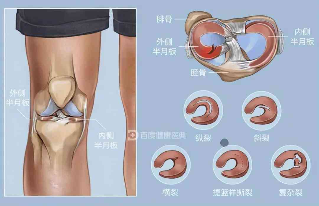 五年病：半月板损伤复之路追踪