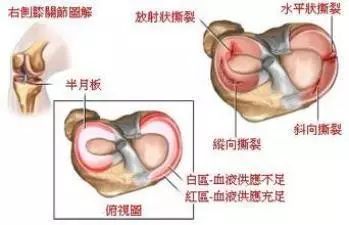 五年病：半月板损伤复之路追踪