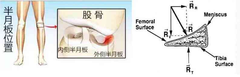 工伤认定：半月板损伤是否纳入工伤范畴》