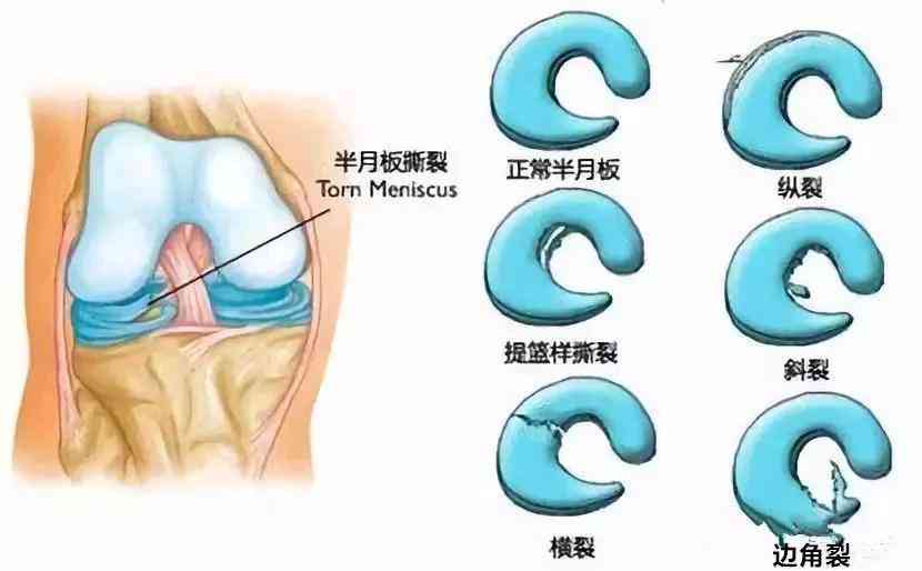 半月板损伤伤残等级评定与认定标准解析