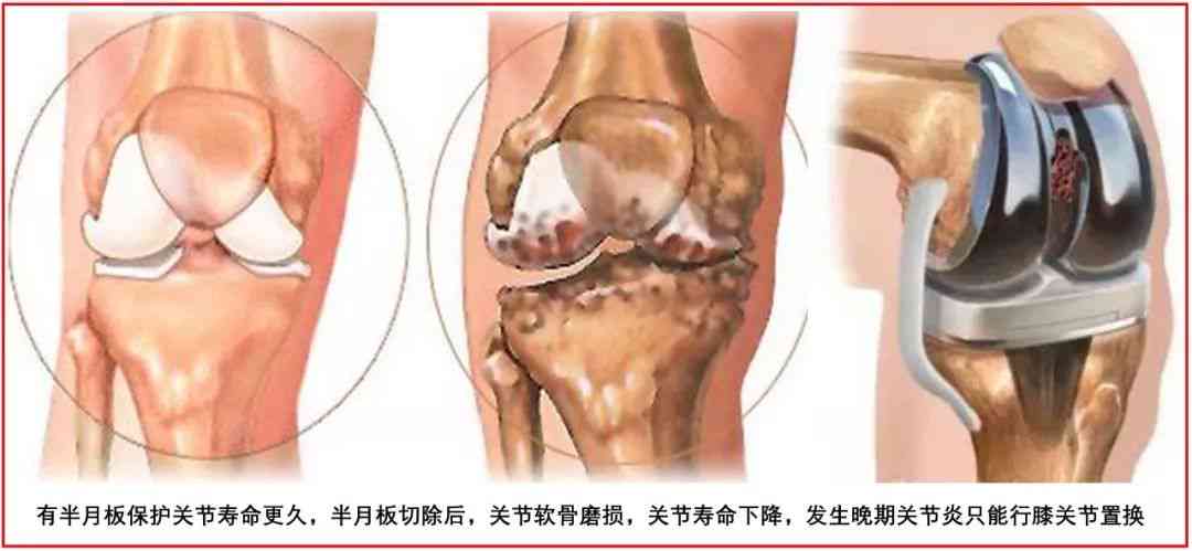 半月板损伤工伤等级认定详解：手术与否、损伤程度与工伤级别判定