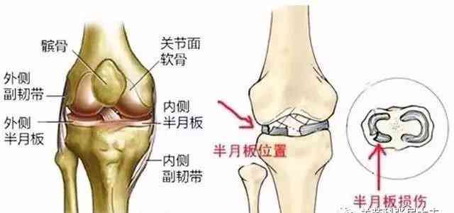 半月板损伤工伤等级认定详解：手术与否、损伤程度与工伤级别判定