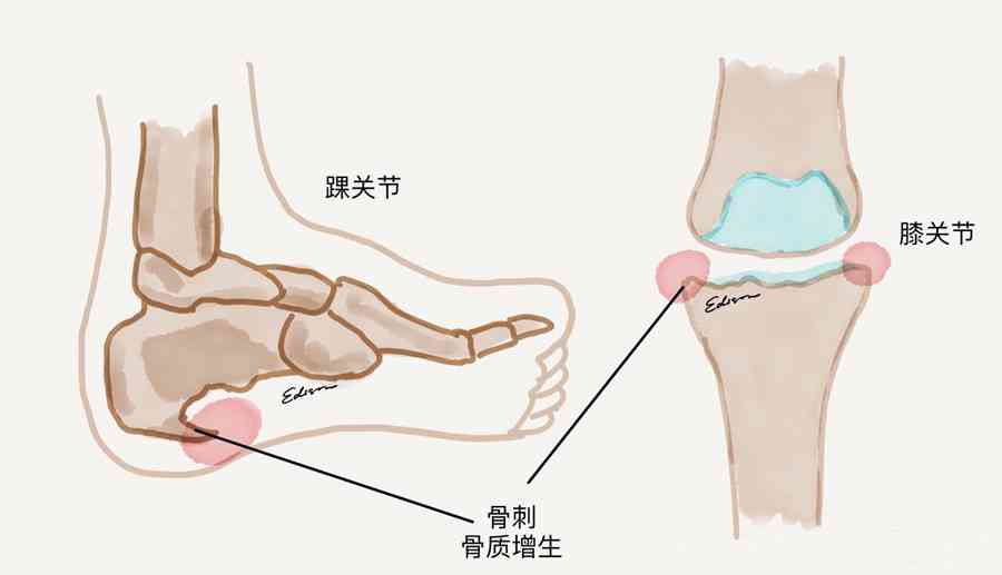 膝关节半月板损伤伤残评定标准与工伤鉴定解析