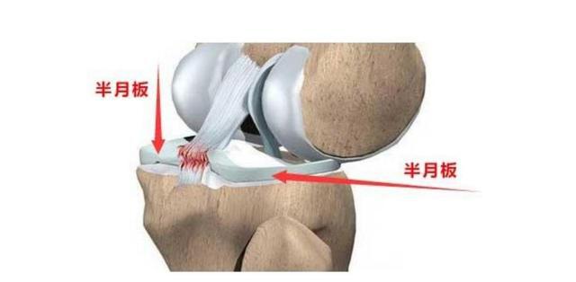 工伤认定：半月板损伤是否属于工伤及赔偿标准解析