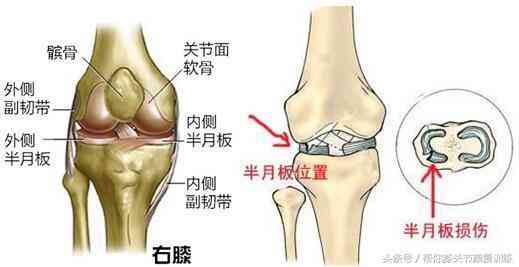 全面解析：半月板损伤工伤认定、赔偿标准及鉴定流程