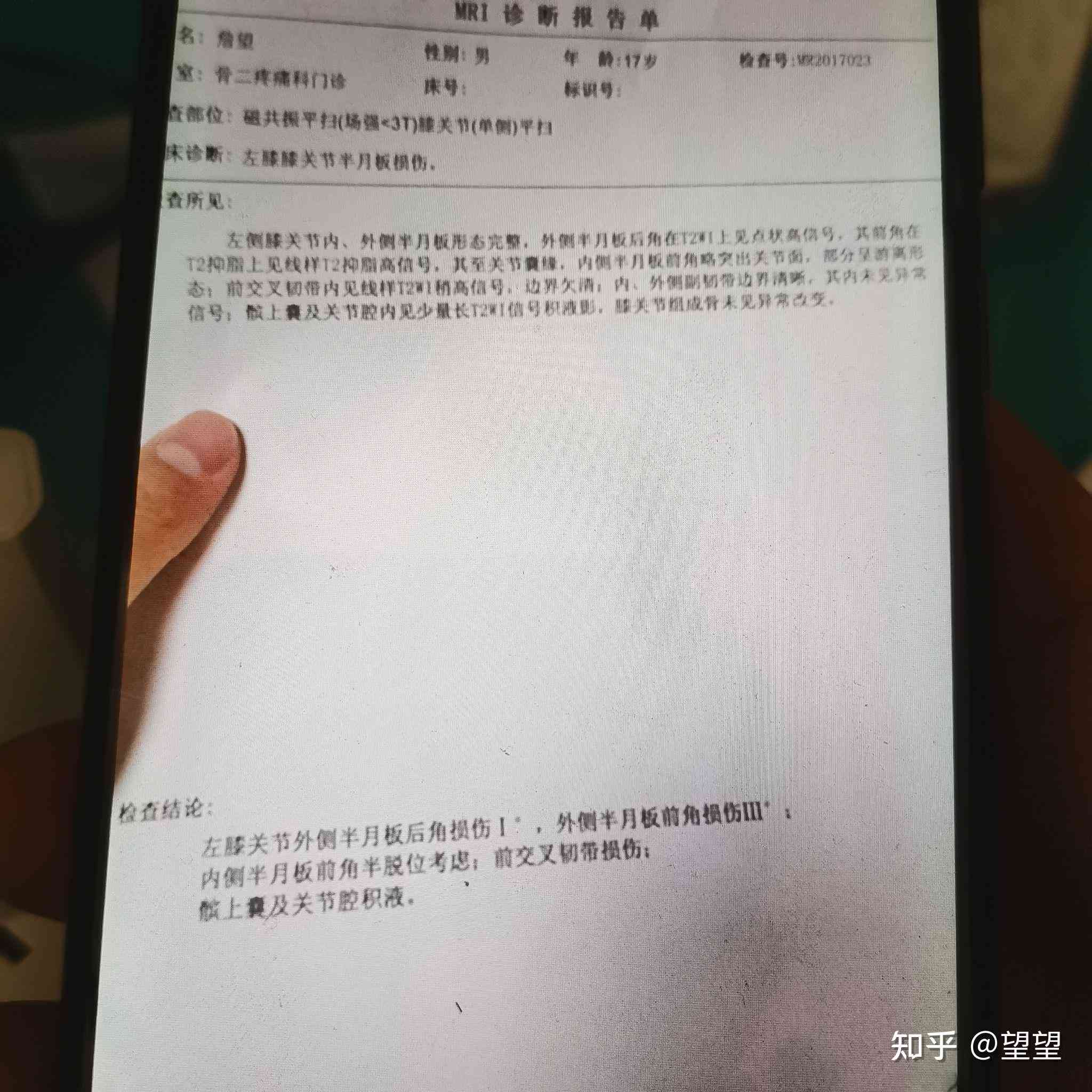 职工半月板撕裂未被认定为工伤