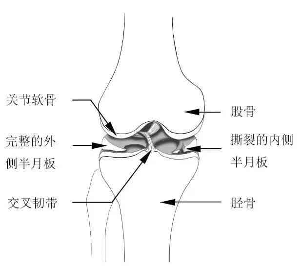 膝关节半月板撕裂工伤认定事故详细报告撰写指南