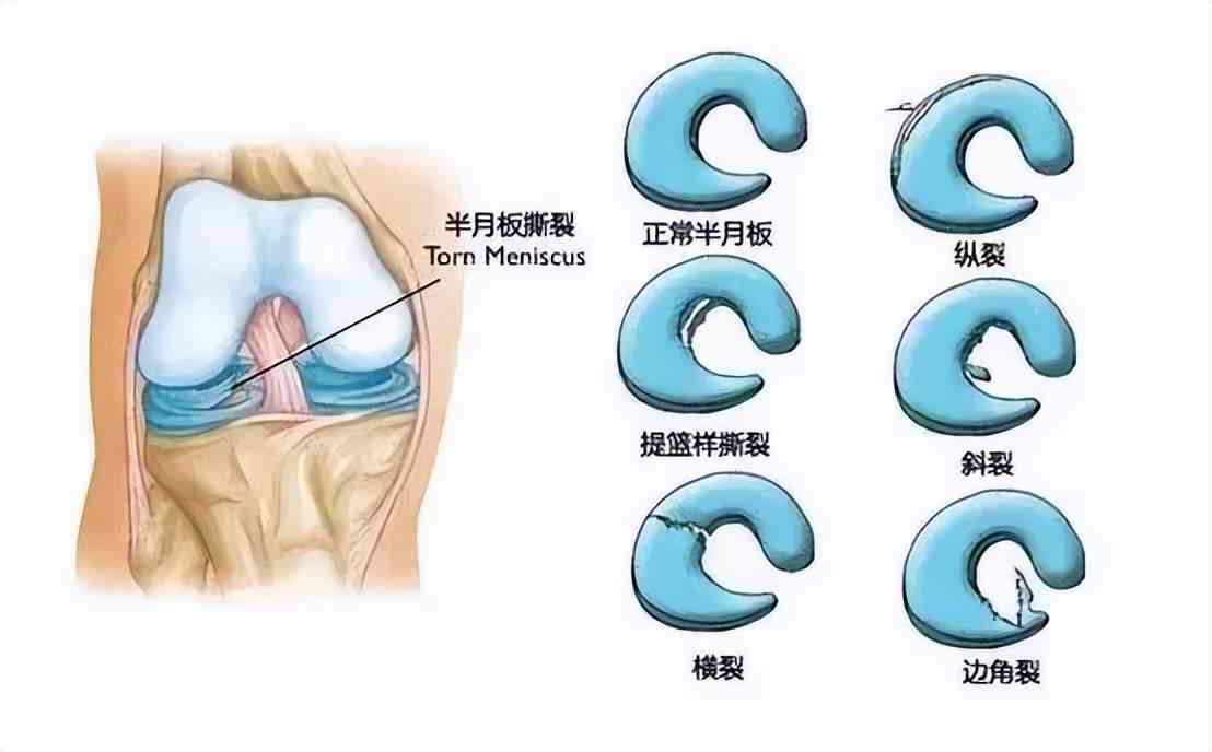 半月板撕裂能认定工伤吗