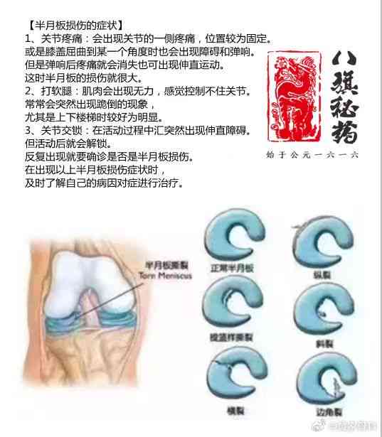 半月板撕裂能认定工伤吗