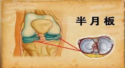 膝关节半月板磨损：工作原因导致的损伤能否被认定为工伤？