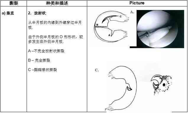 半月板磨损的不可逆性及其综合应对策略解析